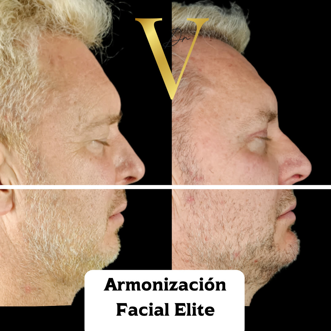 Antes y después de armonización facial: perfil del paciente