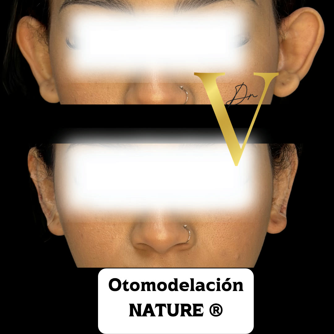 Antes y después de otomodelación con hilos Nature: orejas corregidas sin cirugía