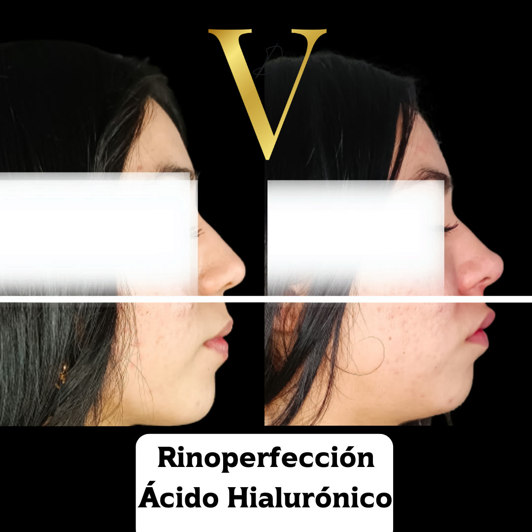 Antes y después de rinoperfección con ácido hialurónico