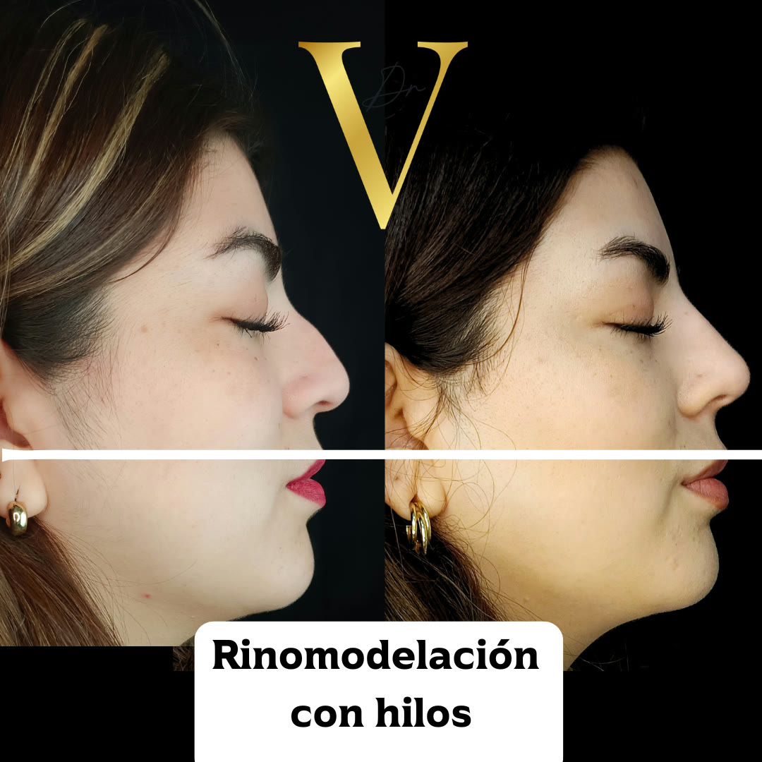 Antes y después de rinomodelación con hilos: perfil nasal sin cirugía